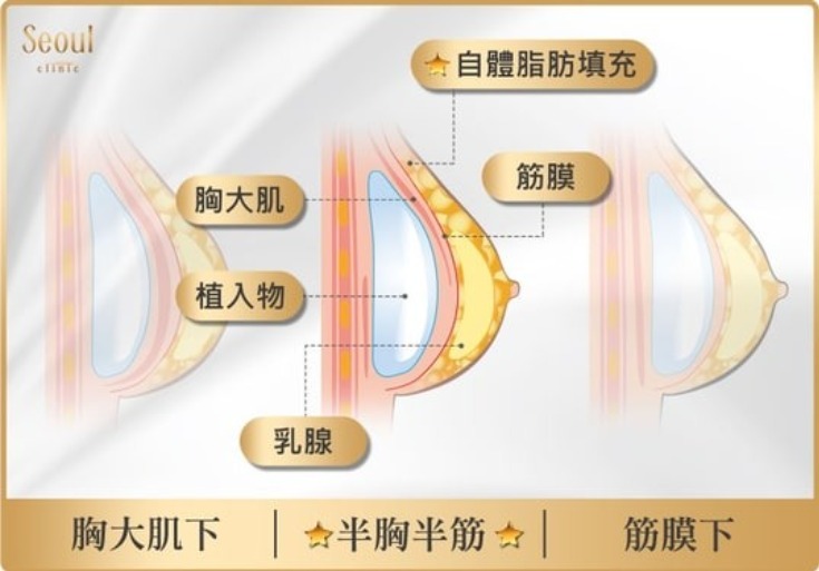 首爾醫美隆乳手術_植入技術介紹