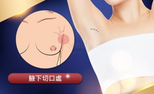 隆乳切口_腋下_首爾醫美