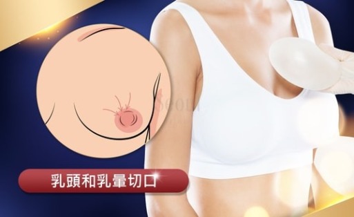 隆乳切口_乳暈乳頭_首爾醫美