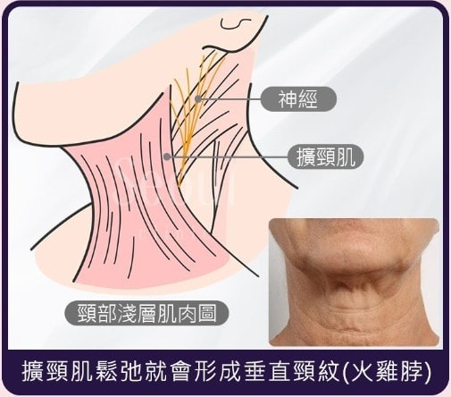 頸紋_火雞脖_首爾醫美