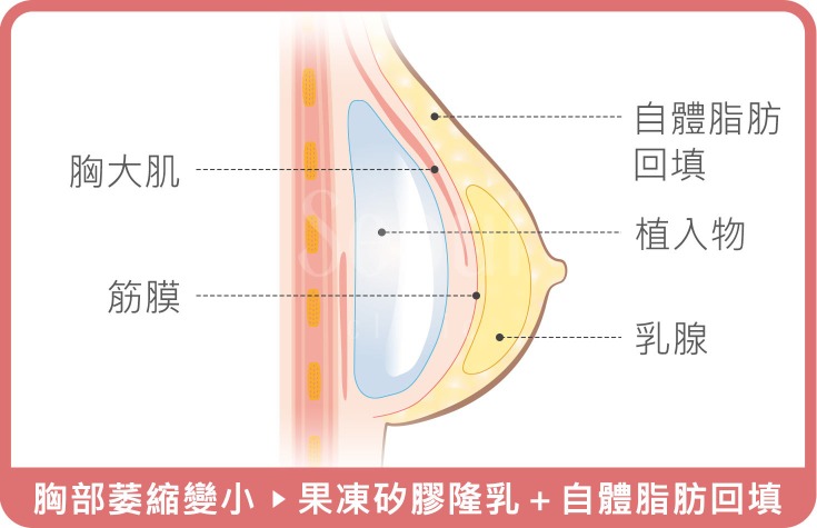 胸部下垂_治療原理_首爾醫美