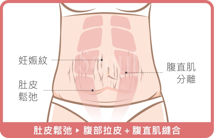 產後肚子鬆弛_首爾醫美