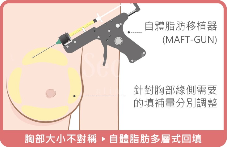 胸部下垂_治療原理_首爾醫美