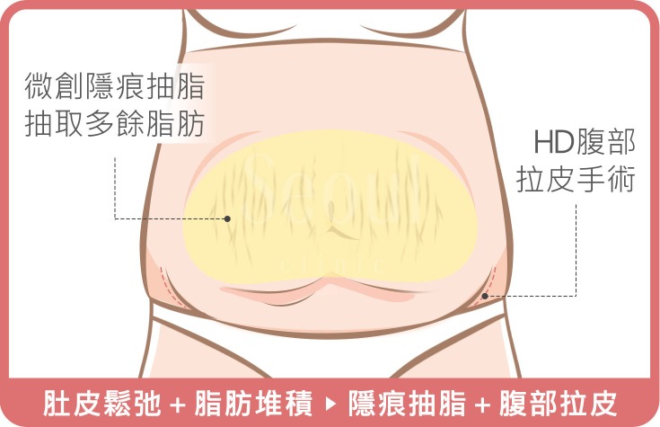 產後肚子鬆弛_首爾醫美