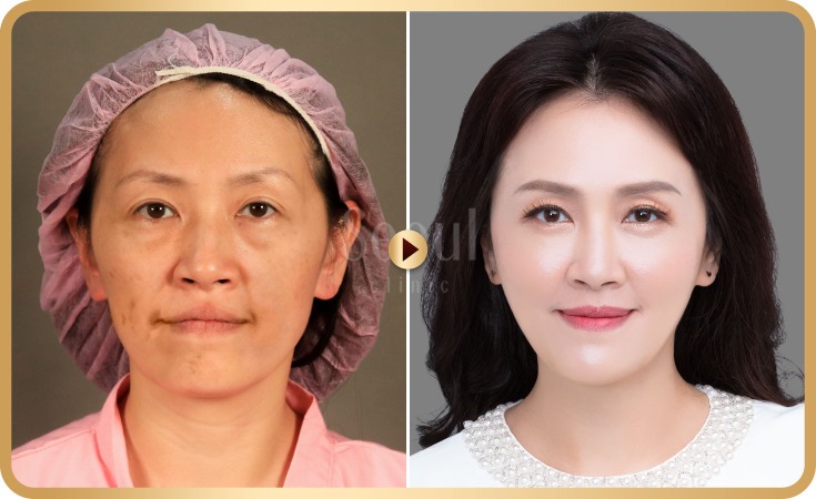 臉頰凹陷比臉大更可怕 打造貴氣桃心臉 自體脂肪補臉 豐頰 手術 Seoul首爾醫美整形