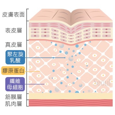 舒顏萃-舒顏萃(聚左旋乳酸)產生作用-首爾醫美