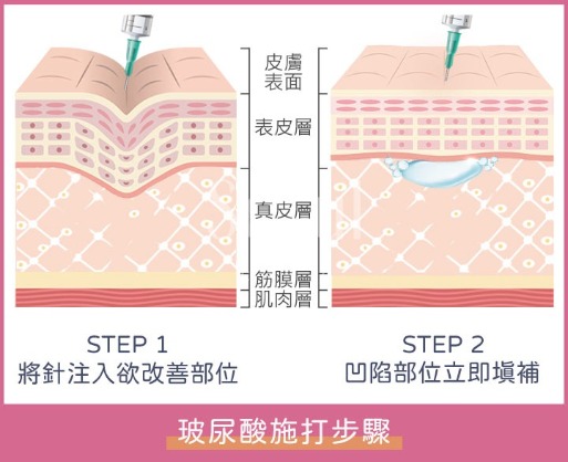 玻尿酸是什麼_首爾醫美診所