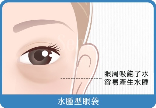 水腫型眼袋_首爾醫美診所
