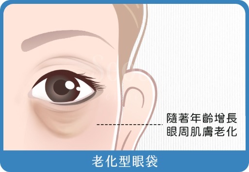 老化型眼袋_首爾醫美診所