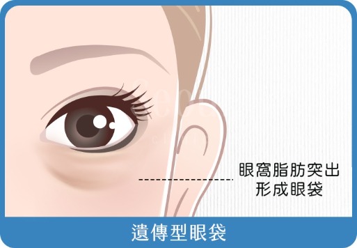 遺傳型眼袋_首爾醫美診所