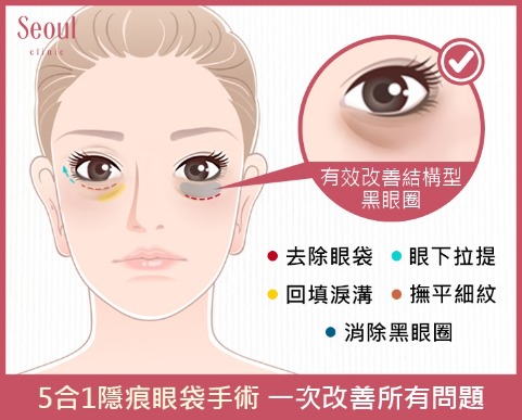 5合1隱痕眼袋手術一次改善包含黑眼圈等所有問題
