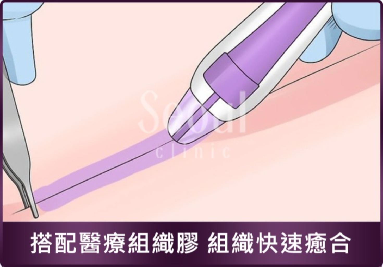 首爾醫美隆乳手術_儀器介紹