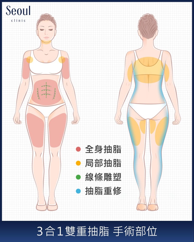 三合一雙重抽脂-抽脂手術適應部位-首爾醫美