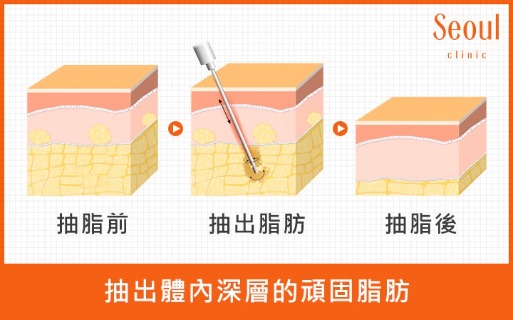 抽脂手術-抽脂原理-首爾醫美