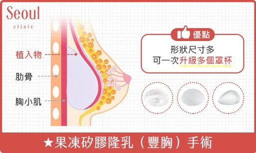 豐胸_果凍矽膠隆乳（豐胸）手術_首爾醫美