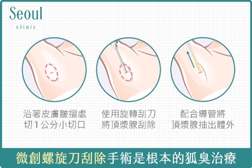 狐臭-狐臭治療4：微創螺旋刀刮除手術-首爾醫美