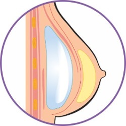 隆乳手術_半筋膜下_首爾醫美