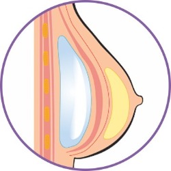 隆乳手術_胸大肌下_首爾醫美