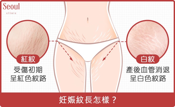 腹部拉皮_妊娠紋長怎樣?_首爾醫美