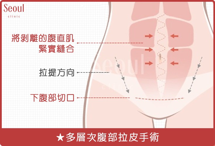 妊娠紋消除方法-多層次腹部拉皮手術-首爾醫美