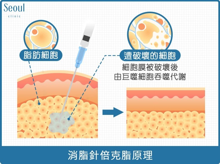 消脂針-消脂針倍克脂原理-首爾醫美