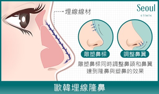 埋線隆鼻_歐韓埋線隆鼻_首爾醫美