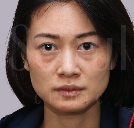 五合一眼袋手術-臉部案例-施作前-首爾醫美