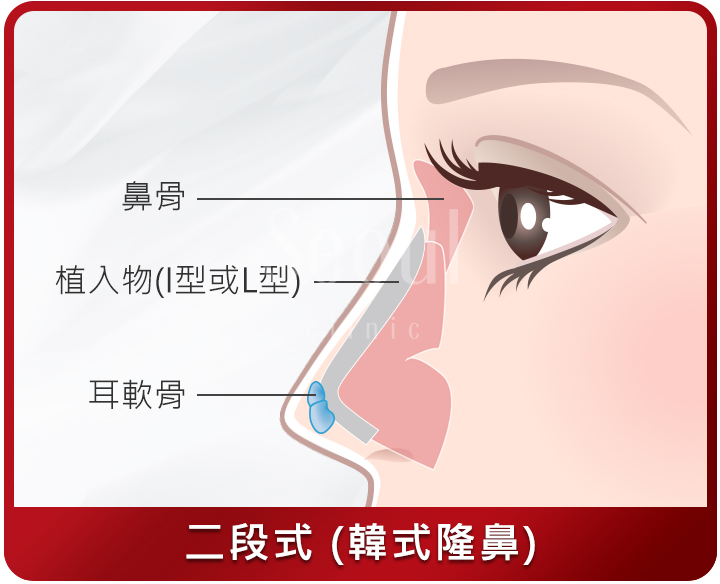 隆鼻_二段式隆鼻手術_首爾醫美