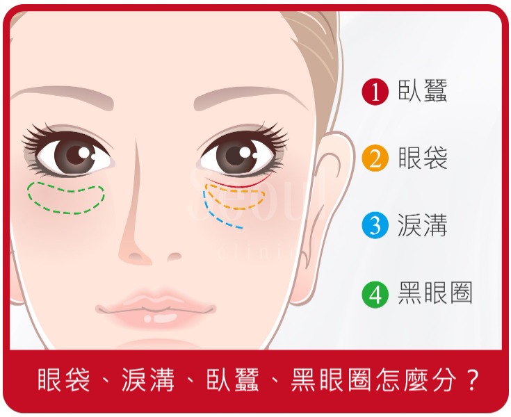 眼袋手術_眼袋、淚溝、臥蠶、黑眼圈怎麼分？_首爾醫美