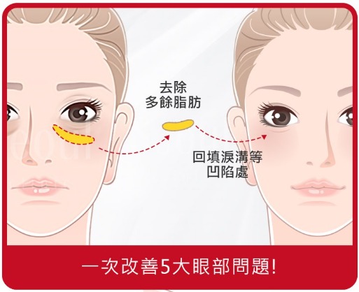 一次改善5大眼部問題_首爾醫美
