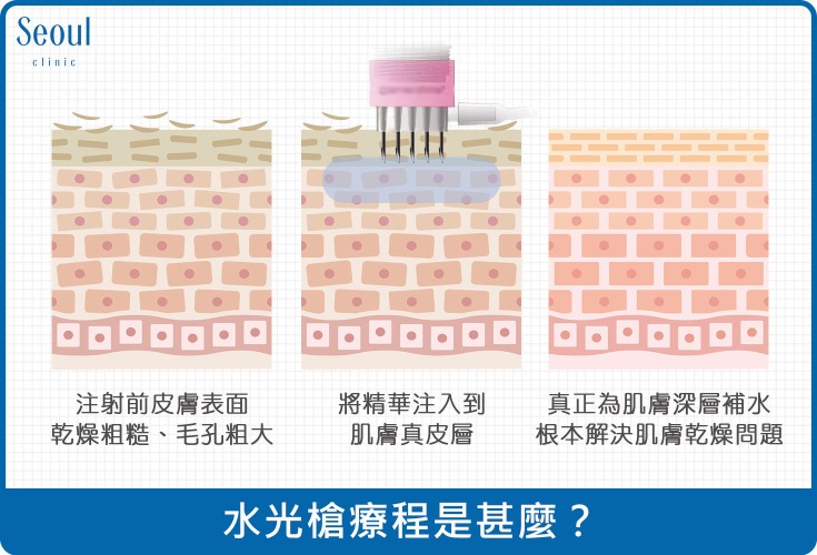 水光針-水光針療程是什麼？-首爾醫美