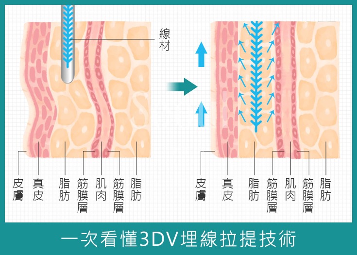 埋線拉提_埋線拉提技術_首爾醫美