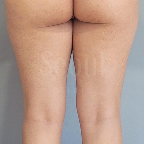 台中抽脂推薦-首爾醫美三合一抽脂手術-大腿抽脂術前分享照