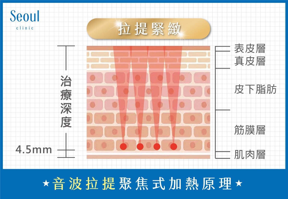 Q+立線音波-音波拉提聚焦式加熱原理-首爾醫美