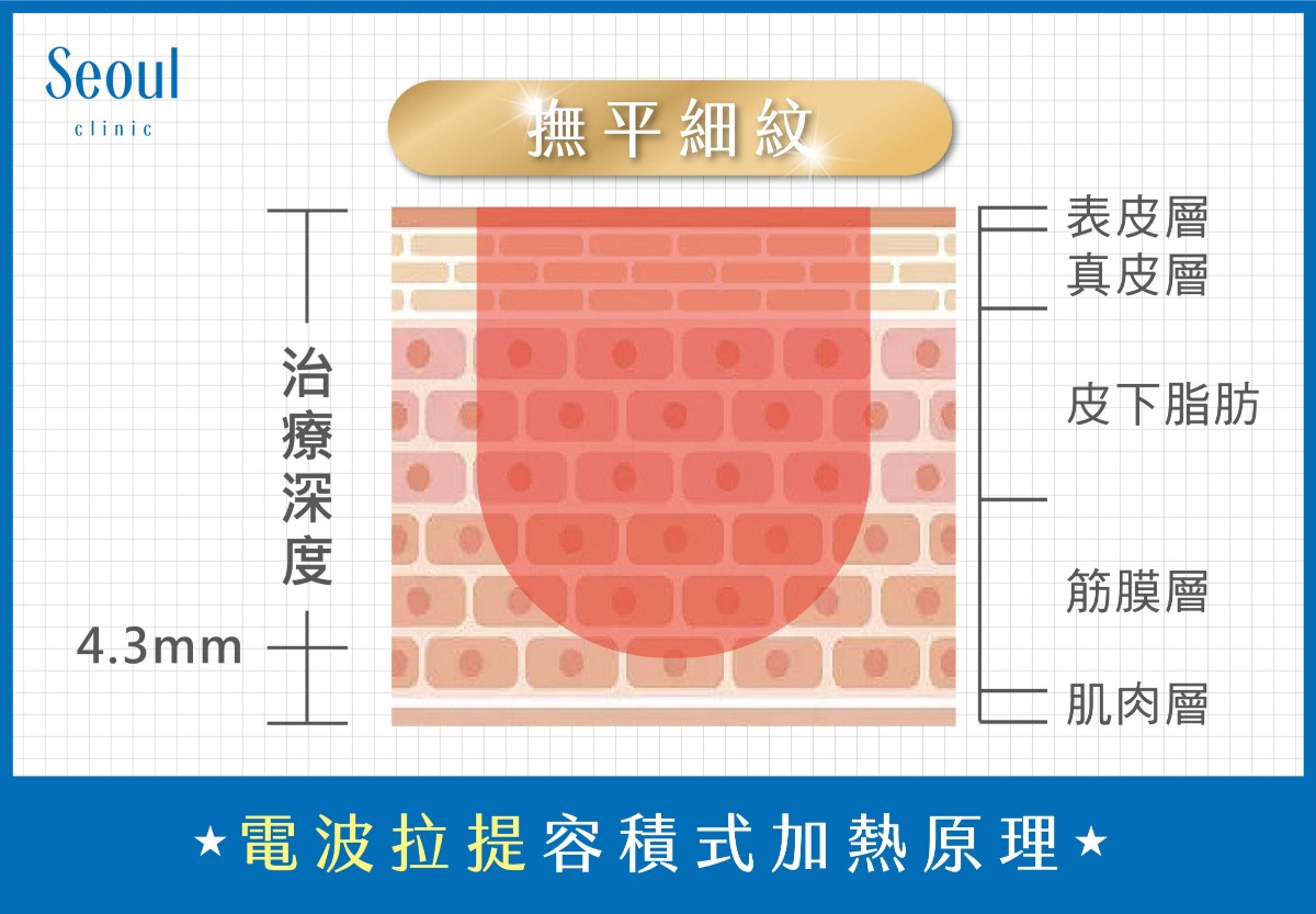 Q+立線音波-電波拉提容積式加熱原理-首爾醫美