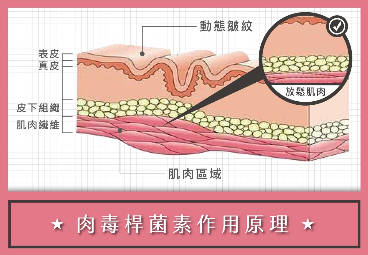 肉毒-肉毒桿菌作用原理-首爾醫美