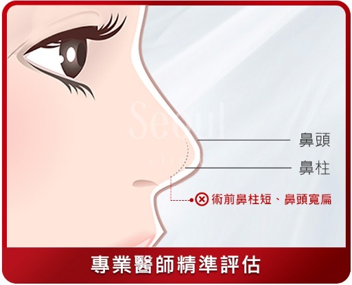 隆鼻-鼻頭、鼻柱專業醫師精準評估-首爾醫美