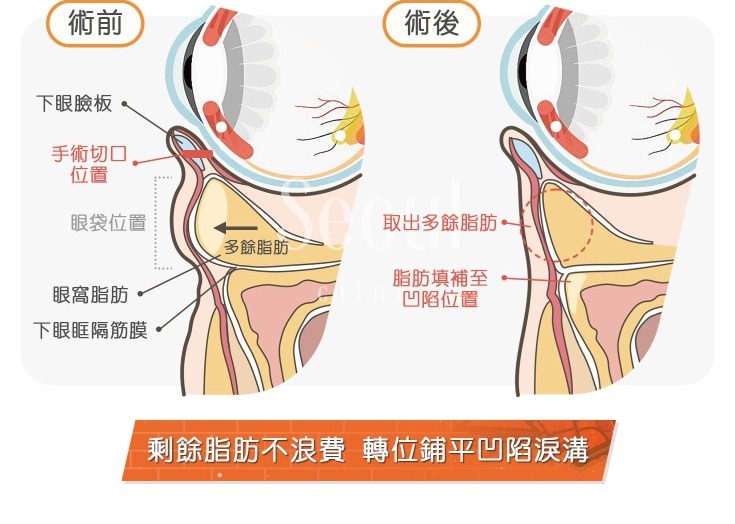 五合一隱痕眼袋手術-剩餘的脂肪不浪費，用於鋪平淚溝-首爾醫美診所