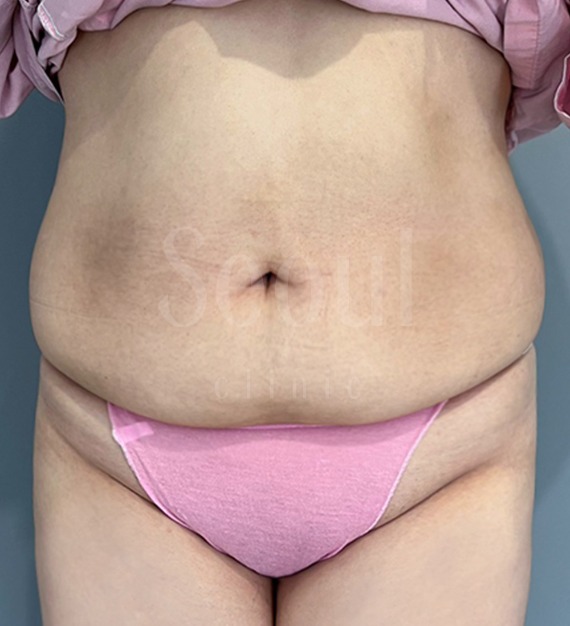 台中抽脂推薦-首爾醫美三合一抽脂手術-腹部抽脂術前分享照