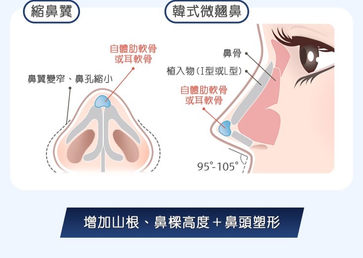 五合一隱痕眼袋手術-剩餘的脂肪不浪費，用於鋪平淚溝-首爾醫美診所