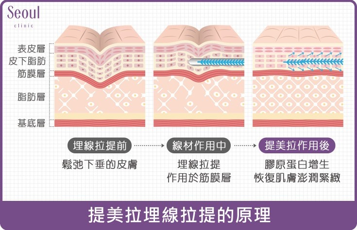 提美拉-提美拉埋線拉提原理-首爾醫美診所