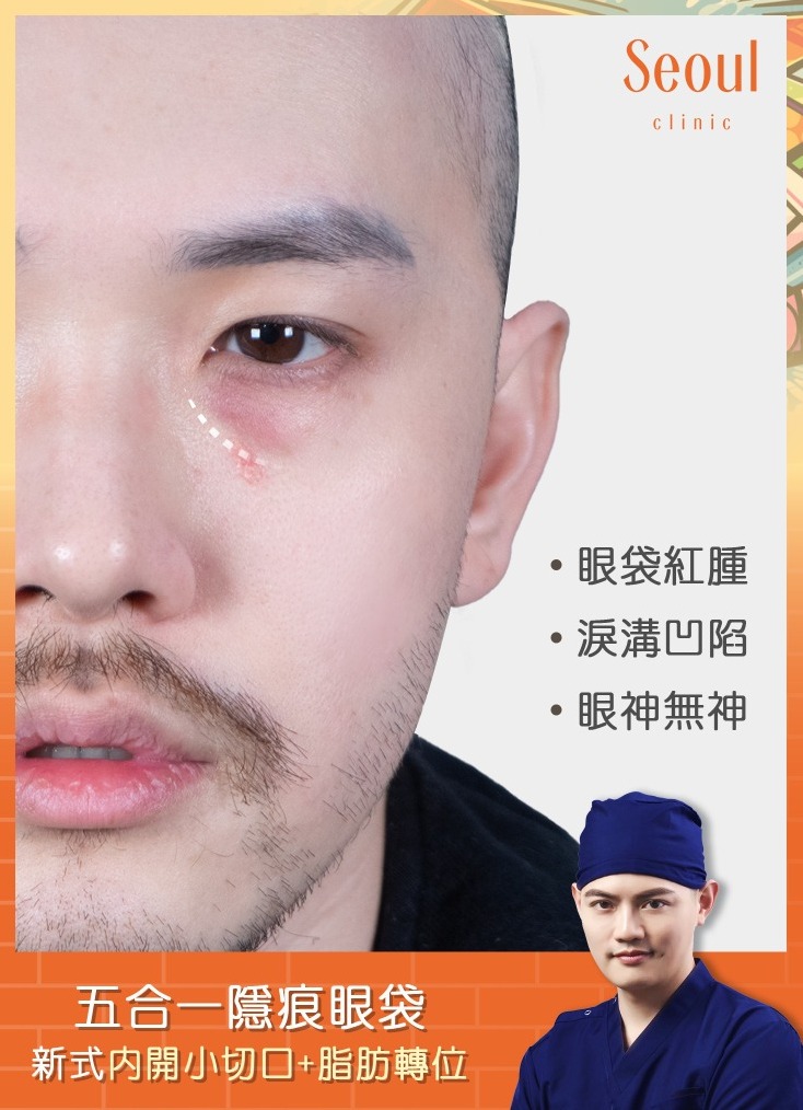 五合一隱痕眼袋手術-眼袋紅腫，加上淚溝，疲憊感倍增-首爾醫美診所
