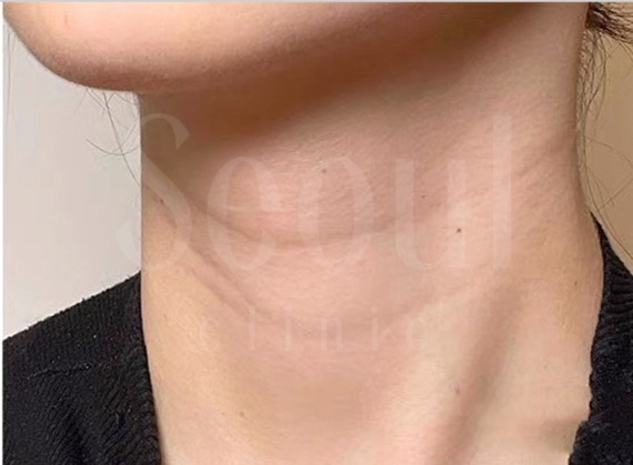 海芙音波-頸部皺紋明顯-首爾醫美