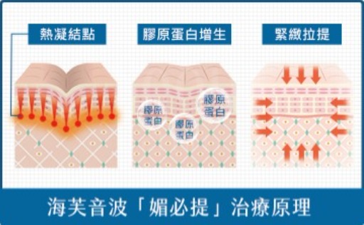 海芙音波-海芙音波第四代「媚必提」治療原理-首爾醫美