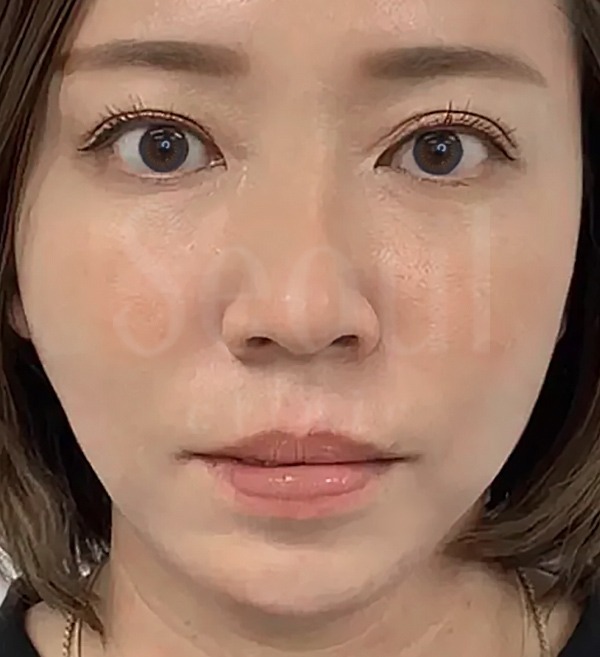 海芙音波-全臉術後三個月-首爾醫美