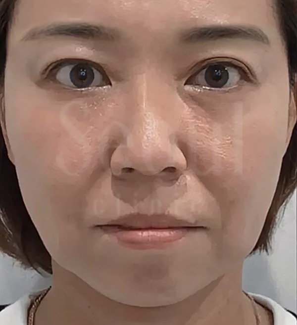 海芙音波-全臉肌膚鬆弛-首爾醫美