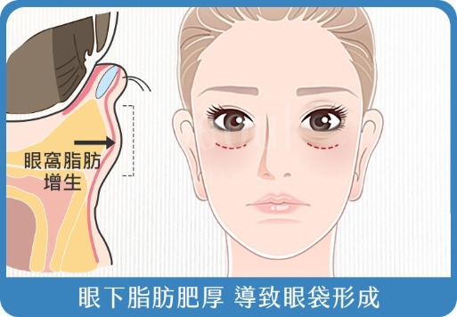 眼袋-眼下脂肪肥厚導致眼袋形成-首爾醫美診所