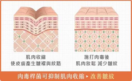 肉毒-肉毒桿菌可抑制肌肉收縮-首爾醫美