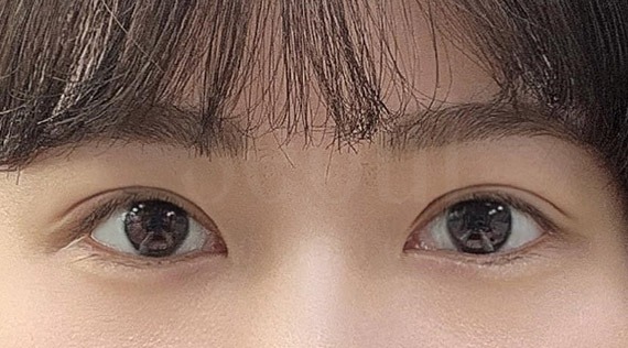 雙眼皮_縫雙眼皮手術後一個月_首爾醫美