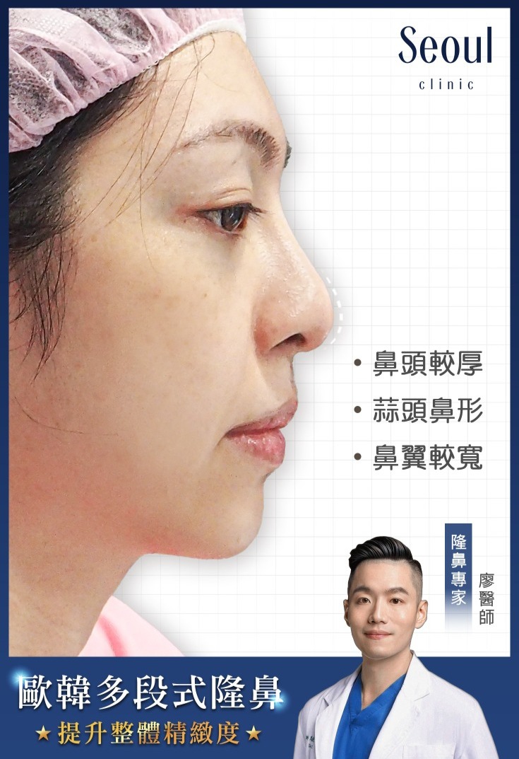 五合一隱痕眼袋手術-眼袋紅腫，加上淚溝，疲憊感倍增-首爾醫美診所